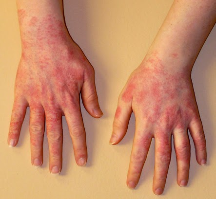 Why Allergies Might Someday Mean the End of Latex Gloves
